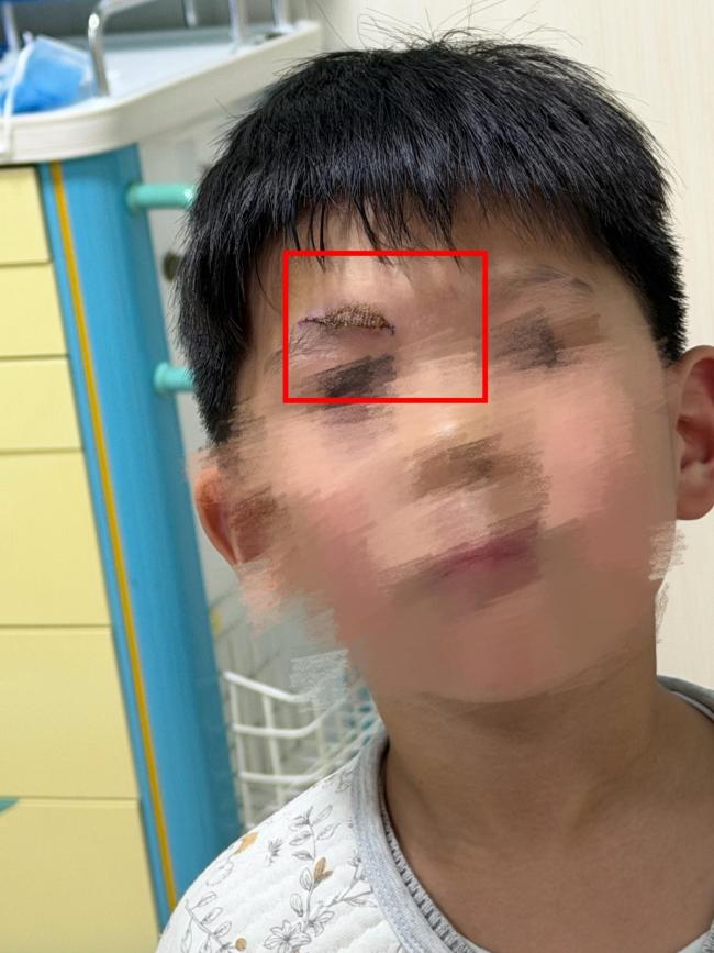 男童游乐场摔伤 家长索祛疤费遭拒 安全隐患引争议(2)