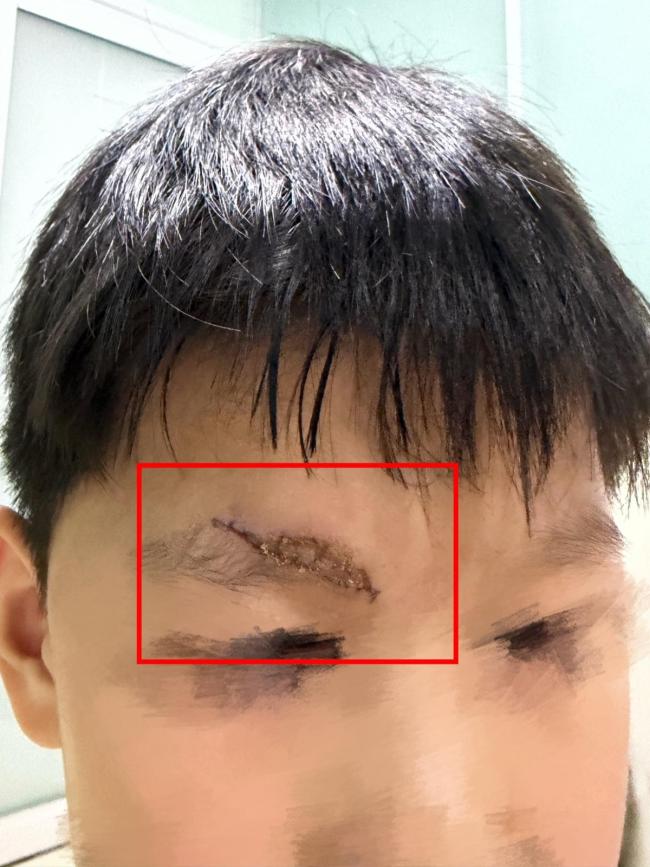 男童游乐场摔伤 家长索祛疤费遭拒 安全隐患引争议