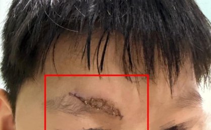 男童游乐场摔伤 家长索祛疤费遭拒 安全隐患引争议